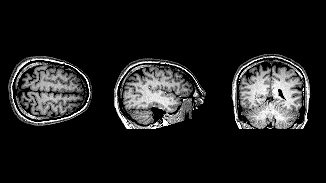 MRI_brain_scan_node_full_image_2.gif